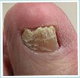 LASER THERAPY TREATMENT FOR NAIL FUNGUS